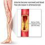 Do not ignore Legs Ace it can be symptoms for heart Diseases and paralysis