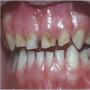 UnCleand Teeth can cause heart diseases