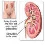 Which people are more likely to get  Kidney Stones Disease