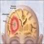 Brain Tumor Disease spreading very fast in tribal areas
