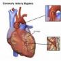 heart diseases angioplasty or ByPass Surgery  which is better angioplasty was co