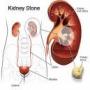 how to get rid of Stone in Kidney What should we do how to avoid it Tips and Tricks for stones in Kidney Disease