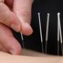 Acupuncture Getting famous in western countries also Acupuncture enters steroids needles in patient body while no pain